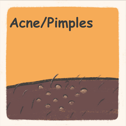Illustration depicting skin with pimples or acne.